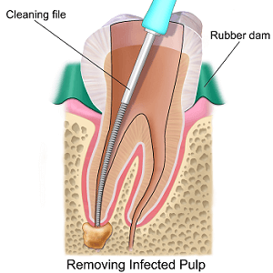 root canal treatment in kitchener